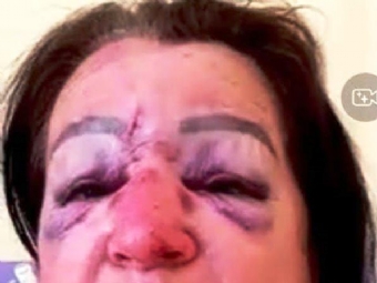 Mulher cai de scooter e fica ferida aps ser atacada por ces soltos em Juranda; neta tambm estava no veculo